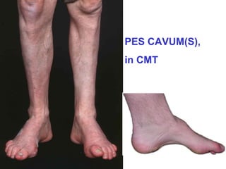 PES CAVUM(S),
in CMT

 