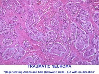 TRAUMATIC NEUROMA
“Regenerating Axons and Glia (Schwann Cells), but with no direction”

 