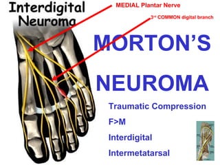 MEDIAL Plantar Nerve
3rd COMMON digital branch

MORTON’S
NEUROMA
Traumatic Compression
F>M
Interdigital
Intermetatarsal

 