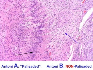 Antoni A: “Palisaded”

Antoni B: NON-Palisaded

 