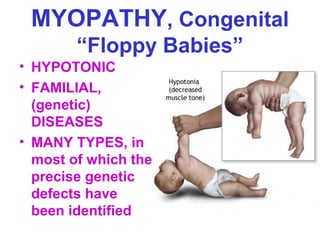 MYOPATHY, Congenital
“Floppy Babies”
• HYPOTONIC
• FAMILIAL,
(genetic)
DISEASES
• MANY TYPES, in
most of which the
precise genetic
defects have
been identified

 