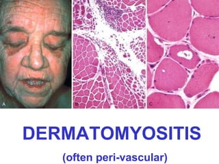 DERMATOMYOSITIS
(often peri-vascular)

 