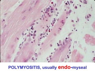 POLYMYOSITIS, usually endo-myseal

 