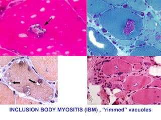 INCLUSION BODY MYOSITIS (IBM) , “rimmed” vacuoles

 