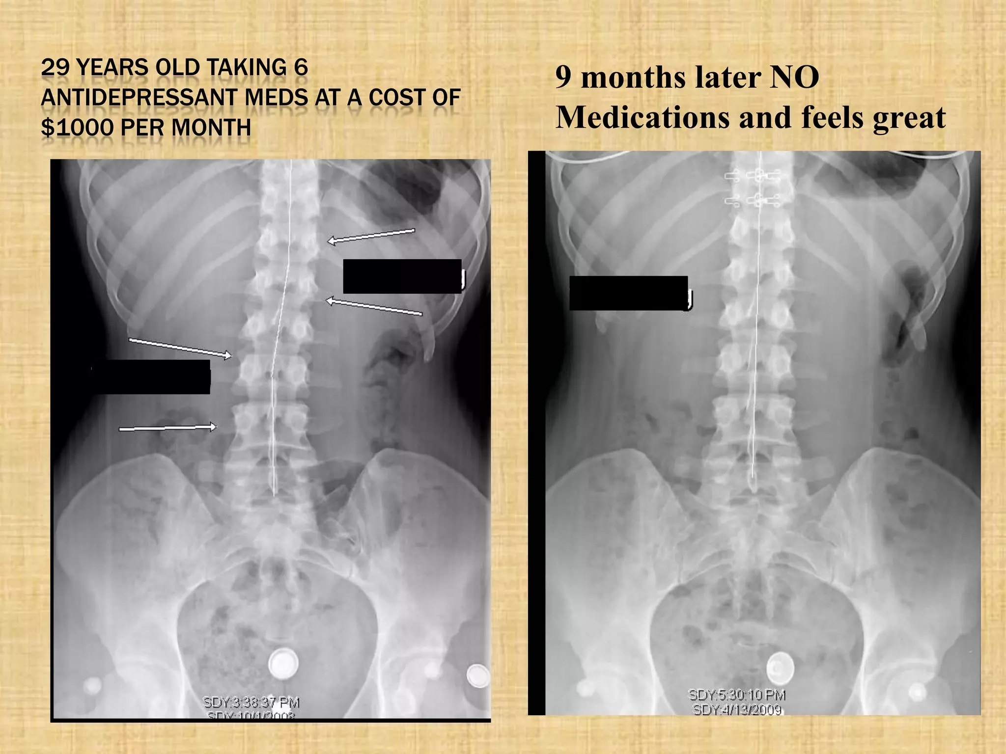 29 YEARS OLD TAKING 6
ANTIDEPRESSANT MEDS AT A COST OF
$1000 PER MONTH
9 months later NO
Medications and feels great
 