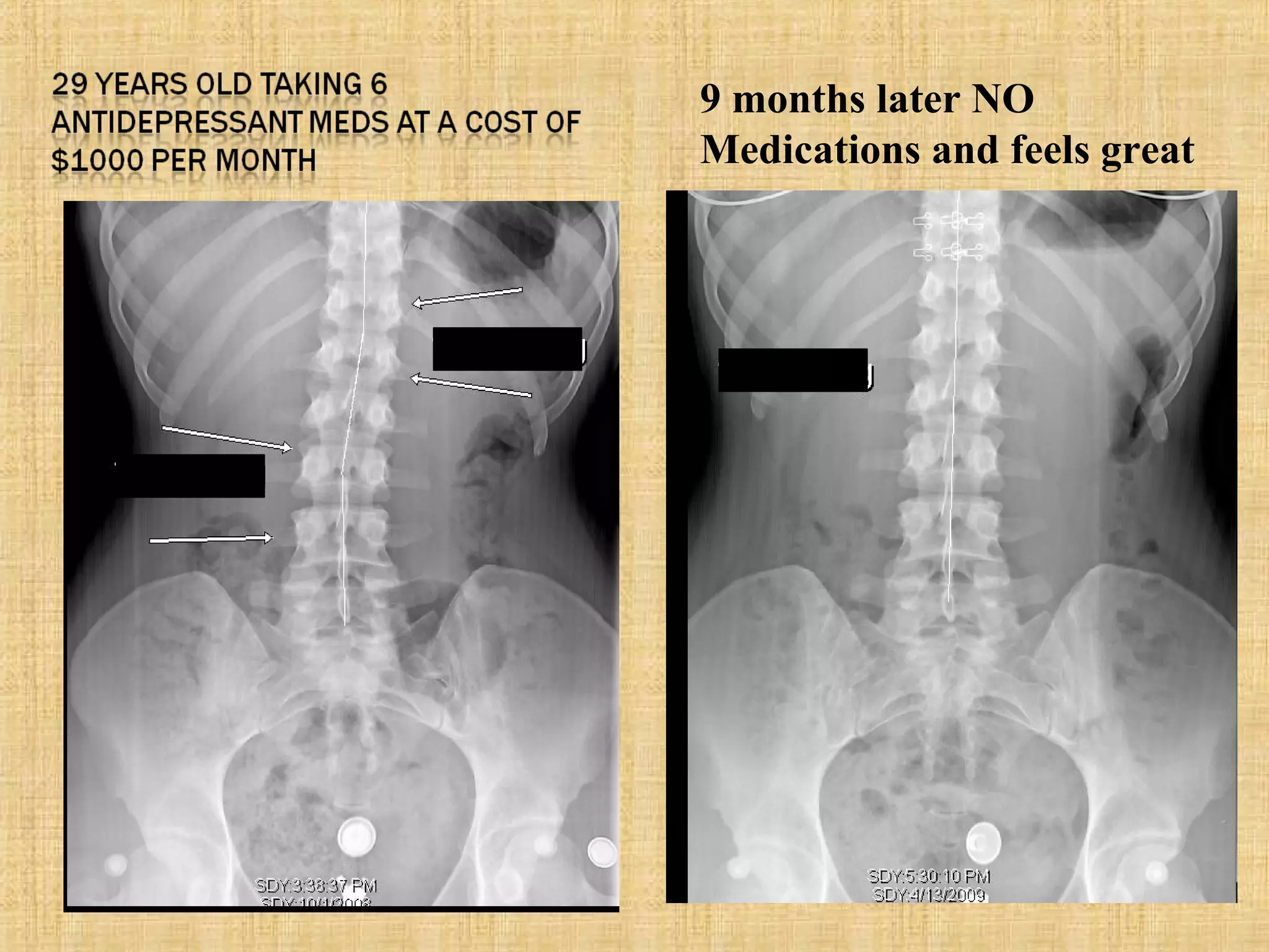 9 months later NO
Medications and feels great
 