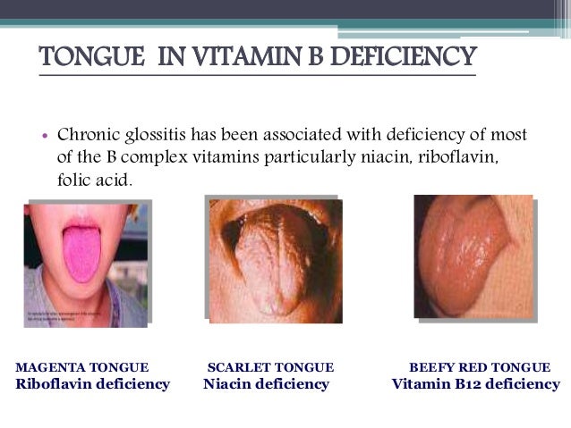Beefy Red Tongue Vitamin Deficiency – DHSFK