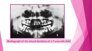 Radiograph of the mixed dentition of a 7-year-old child
 