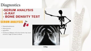 Mineral and Bone Disorder in Chronic Kidney Disease O-H.pdf