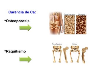 Carencia de Ca:
Osteoporosis
Raquitismo
 