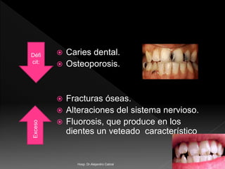  Caries dental.
 Osteoporosis.
 Fracturas óseas.
 Alteraciones del sistema nervioso.
 Fluorosis, que produce en los
dientes un veteado característico
Défi
cit:
Exceso
Hosp. Dr.Alejandro Cabral
 
