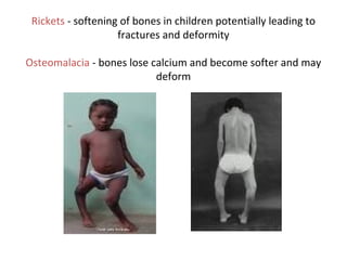 Rickets - softening of bones in children potentially leading to
fractures and deformity
Osteomalacia - bones lose calcium and become softer and may
deform
 