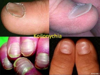 Koilonychia
 