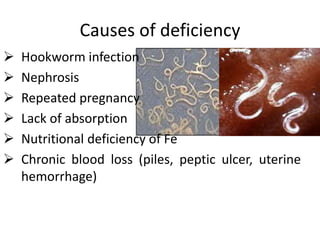Causes of deficiency
 Hookworm infection
 Nephrosis
 Repeated pregnancy
 Lack of absorption
 Nutritional deficiency of Fe
 Chronic blood loss (piles, peptic ulcer, uterine
hemorrhage)
 