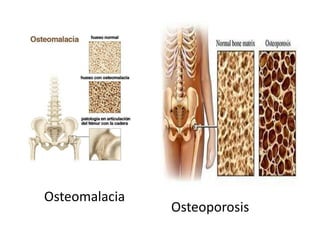 Osteomalacia
Osteoporosis
 