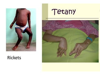 Rickets
 