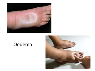 Oedema
 