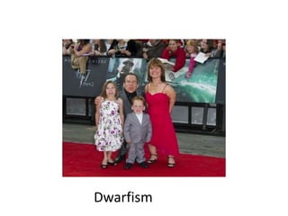 Dwarfism
 
