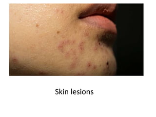 Skin lesions
 