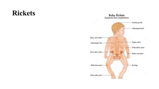 Rickets
 