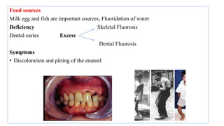 Food sources
Milk egg and fish are important sources, Fluoridation of water
Deficiency Skeletal Fluorosis
Dental caries Excess
Dental Fluorosis
Symptoms
• Discoloration and pitting of the enamel
 