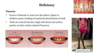 Deficiency
Fluorosis:
• Excess of fluoride in water (or) diet (above 2ppm) in
children causes mottling of enamel & discoloration of teeth.
• Teeth are weak & become rough with brown (or) yellow
patches on their surface (dental Fluorosis).
skeletal fluorosis
 