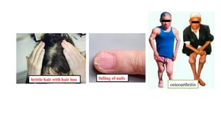 brittle hair with hair loss falling of nails
osteoarthritis
 
