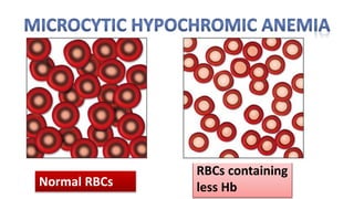 Normal RBCs
Small sized
RBCs containing
less Hb
 