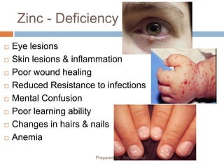 Zinc - Deficiency
Prepared By: Sidra Javed
 Eye lesions
 Skin lesions & inflammation
 Poor wound healing
 Reduced Resistance to infections
 Mental Confusion
 Poor learning ability
 Changes in hairs & nails
 Anemia
 