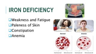 IRON DEFICIENCY
Weakness and Fatigue
Paleness of Skin
Constipation
Anemia
 