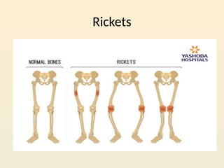 Rickets Graph Minerals unit 6 for Nursing Students.pptx