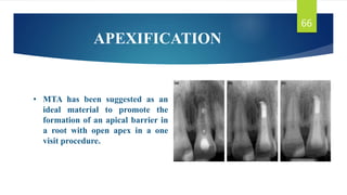 Mta Rsetting Reaction MINERAL TRIOXIDE AGGREGATE presentation.pptx