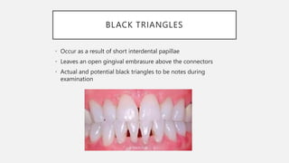 BLACK TRIANGLES
• Occur as a result of short interdental papillae
• Leaves an open gingival embrasure above the connectors
• Actual and potential black triangles to be notes during
examination
 