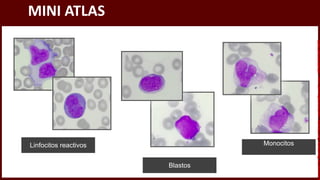 MINI ATLAS
Linfocitos reactivos
Blastos
Monocitos
Licensed
to
Remberto
Cari
Hojeda
-
carihojeda@gmail.com
-
HP46816324875423
 