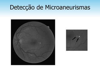 Detecção de Microaneurismas
 