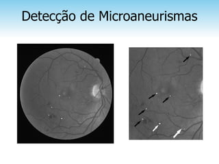 Detecção de Microaneurismas
 