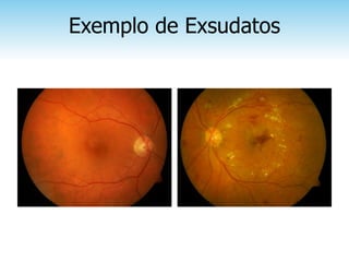 Exemplo de Exsudatos
 