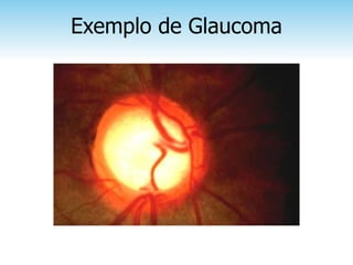 Exemplo de Glaucoma
 