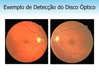 Exemplo de Detecção do Disco Óptico
 