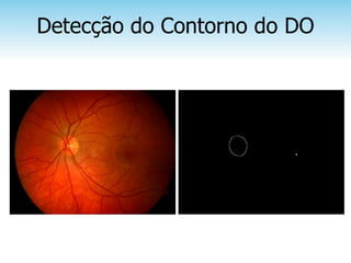 Detecção do Contorno do DO
 