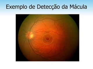 Exemplo de Detecção da Mácula
 