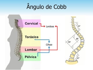 Ângulo de Cobb


      Lordose




      Cifose
 