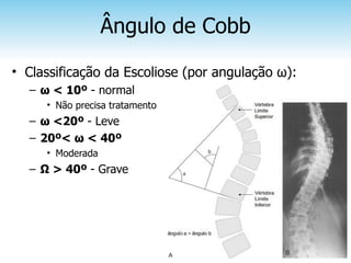 Ângulo de Cobb
• Classificação da Escoliose (por angulação ω):
  – ω < 10º - normal
     • Não precisa tratamento
  – ω <20º - Leve
  – 20º< ω < 40º
     • Moderada
  – Ω > 40º - Grave
 