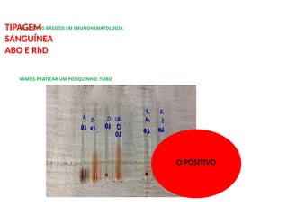CONCEITOS BÁSICOS EM IMUNOHEMATOLOGIA
TIPAGEM
SANGUÍNEA
ABO E RhD
VAMOS PRATICAR UM POUQUINHO: TUBO
O POSITIVO
 
