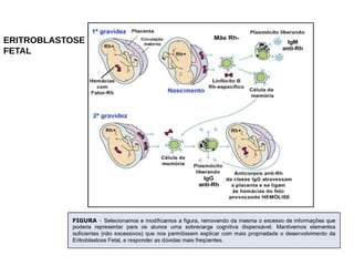 ERITROBLASTOSE
FETAL
 
