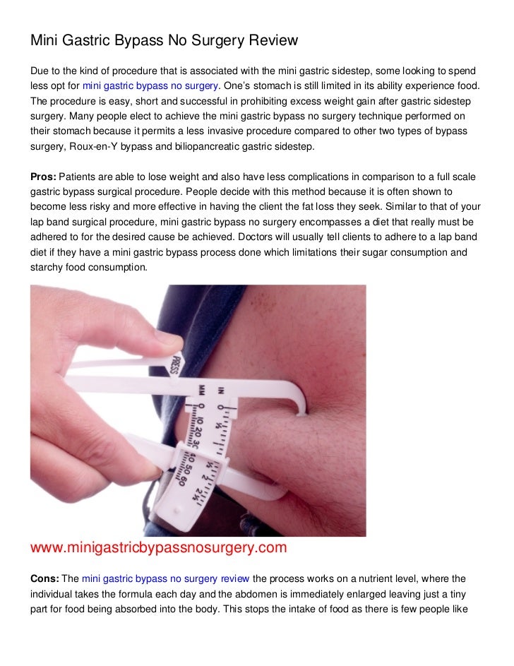 mini gastric bypass no surgery review mini gastric bypass