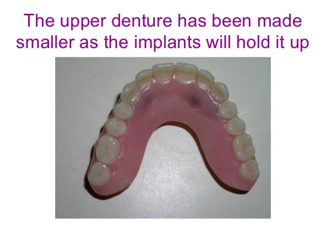 Secure Denture Adhesive >> Mini implants Secure Denture Adhesive >> Mini implants