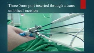 Three 5mm port inserted through a trans
umbilical incision
 