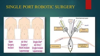 SINGLE PORT ROBOTIC SURGERY
 