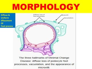 MORPHOLOGY
Diffuse &
Uniform
Effacement
Of
Foot process
 
